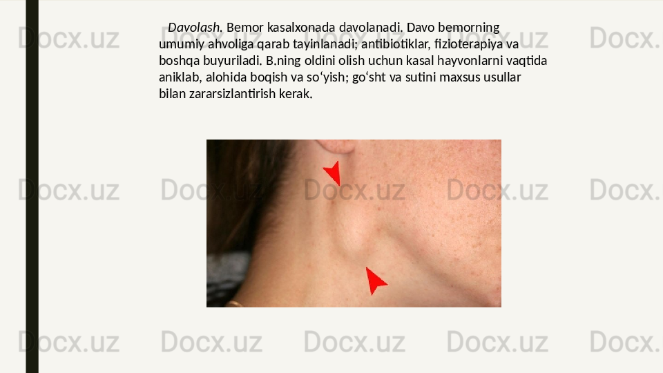     Davolash.  Bemor kasalxonada davolanadi. Davo bemorning 
umumiy ahvoliga qarab tayinlanadi; antibiotiklar, fizioterapiya va 
boshqa buyuriladi. B.ning oldini olish uchun kasal hayvonlarni vaqtida 
aniklab, alohida boqish va soʻyish; goʻsht va sutini maxsus usullar 
bilan zararsizlantirish kerak.  