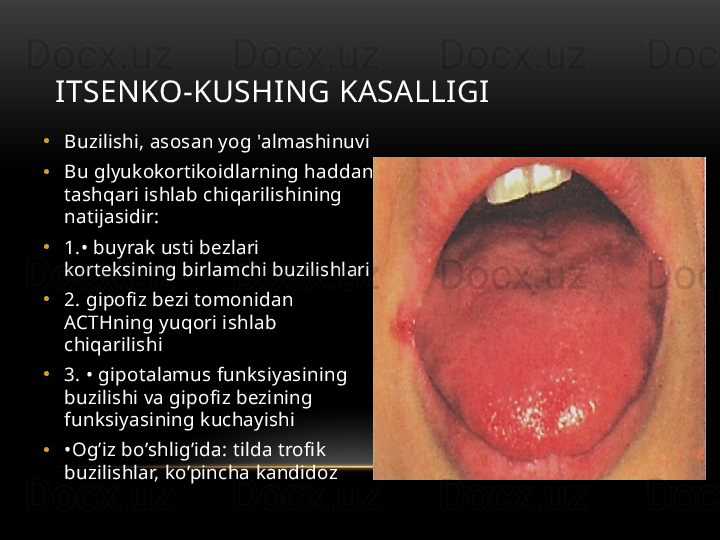 ITSENKO-KUSHING KASALLIGI
•
Buzilishi, asosan yog 'almashinuvi
•
Bu glyukokortikoidlarning haddan 
tashqari ishlab chiqarilishining 
natijasidir:
•
1. • buyrak usti bezlari 
korteksining birlamchi buzilishlari
•
2.  gipofiz bezi tomonidan 
ACTHning yuqori ishlab 
chiqarilishi
•
3.  • gipotalamus funksiyasining 
buzilishi va gipofiz bezining 
funksiyasining kuchayishi
•
• Og’iz bo’shlig’ida: tilda trofik 
buzilishlar, ko’pincha kandidoz 