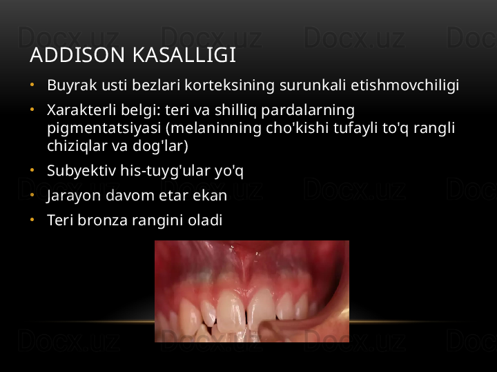 ADDISON KASALLIGI
•
Buyrak usti bezlari korteksining surunkali etishmovchiligi
•
Xarakterli belgi: teri va shilliq pardalarning 
pigmentatsiyasi (melaninning cho'kishi tufayli to'q rangli 
chiziqlar va dog'lar)
•
Subyektiv his-tuyg'ular yo'q
•
Jarayon davom etar ekan
•
Teri bronza rangini oladi 