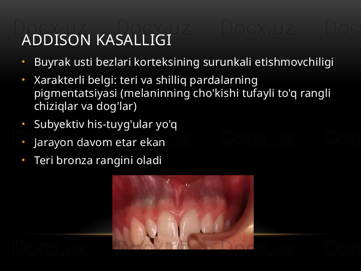 ADDISON KASALLIGI
•
Buyrak usti bezlari korteksining surunkali etishmovchiligi
•
Xarakterli belgi: teri va shilliq pardalarning 
pigmentatsiyasi (melaninning cho'kishi tufayli to'q rangli 
chiziqlar va dog'lar)
•
Subyektiv his-tuyg'ular yo'q
•
Jarayon davom etar ekan
•
Teri bronza rangini oladi