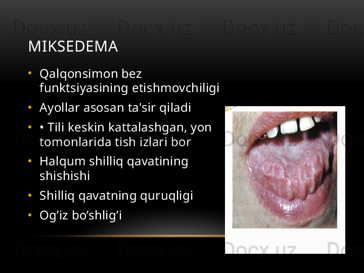 MIKSEDEMA
•
Qalqonsimon bez 
funktsiyasining etishmovchiligi
•
Ayollar asosan ta'sir qiladi
•
•  Tili keskin kattalashgan, yon 
tomonlarida tish izlari bor
•
Halqum shilliq qavatining 
shishishi
•
Shilliq qavatning quruqligi
•
Og’iz bo’shlig’i