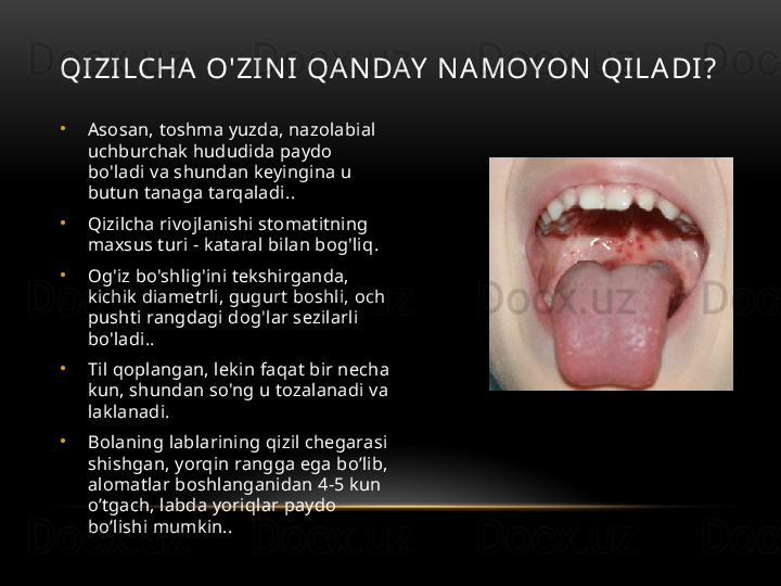 QI ZI LCHA  O' ZI N I  QA N DAY  N A M OY ON  QI L A DI ?
•
Asosan, toshma yuzda, nazolabial 
uchburchak hududida paydo 
bo'ladi va shundan keyingina u 
butun tanaga tarqaladi. .
•
Qizilcha rivojlanishi stomatitning 
maxsus turi - kataral bilan bog'liq .
•
Og'iz bo'shlig'ini tekshirganda, 
kichik diametrli, gugurt boshli, och 
pushti rangdagi dog'lar sezilarli 
bo'ladi. .
•
Til qoplangan, lekin faqat bir necha 
kun, shundan so'ng u tozalanadi va 
laklanadi .
•
Bolaning lablarining qizil chegarasi 
shishgan, yorqin rangga ega bo’lib, 
alomatlar boshlanganidan 4-5 kun 
o’tgach, labda yoriqlar paydo 
bo’lishi mumkin. .