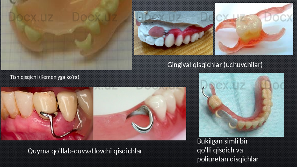 Tish qisqichi (Kemeniyga ko'ra) Gingival qisqichlar (uchuvchilar)
Quyma qo'llab-quvvatlovchi qisqichlar Bukilgan simli bir 
qo'lli qisqich va 
poliuretan qisqichlar