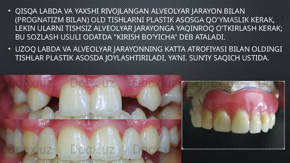 •
QISQA LABDA VA YAXSHI RIVOJLANGAN ALVEOLYAR JARAYON BILAN 
(PROGNATIZM BILAN) OLD TISHLARNI PLASTIK ASOSGA QO'YMASLIK KERAK, 
LEKIN ULARNI TISHSIZ ALVEOLYAR JARAYONGA YAQINROQ O'TKIRLASH KERAK; 
BU SOZLASH USULI ODATDA "KIRISH BO'YICHA" DEB ATALADI.
•
UZOQ LABDA VA ALVEOLYAR JARAYONNING KATTA ATROFIYASI BILAN OLDINGI 
TISHLAR PLASTIK ASOSDA JOYLASHTIRILADI, YA’NI. SUN’IY SAQICH USTIDA. 