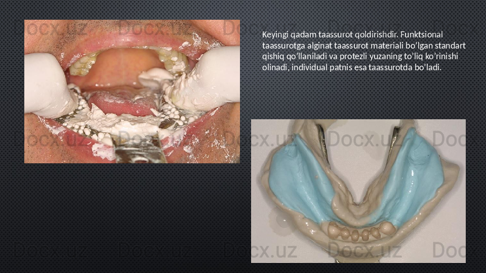 Keyingi qadam taassurot qoldirishdir. Funktsional 
taassurotga alginat taassurot materiali bo’lgan standart 
qishiq qo’llaniladi va protezli yuzaning to’liq ko’rinishi 
olinadi, individual patnis esa taassurotda bo’ladi. 