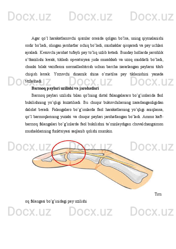 Agar   qo’l   harakatlanuvchi   qismlar   orasida   qolgan   bo’lsa,   uning   qiymalanishi
sodir bo’ladi, olingan jarohatlar ochiq bo’ladi, mushaklar qisqaradi va pay uchlari
ajraladi. Kesuvchi jarohat tufayli pay to’liq uzlib ketadi. Bunday hollarda jarrohlik
o’tkazilishi   kerak,   tiklash   operatsiyasi   juda   murakkab   va   uzoq   muddatli   bo’ladi,
chunki   bilak   vazifasini   normallashtirish   uchun   barcha   zararlangan   paylarni   tikib
chiqish   kerak.   Yozuvchi   dinamik   shina   o’rnatilsa   pay   tiklanishini   yanada
tezlashadi.
Barmoq paylari uzilishi va jarohatlari
Barmoq   paylari   uzilishi   bilan   qo’lning   distal   falangalararo   bo’g’imlarida   faol
bukilishning   yo’qligi   kuzatiliadi.   Bu   chuqur   bukuvchilarning   zararlanganligidan
dalolat   beradi.   Falangalaro   bo’g’imlarda   faol   harakatlarning   yo’qligi   aniqlansa,
qo’l   barmoqlarining   yuzaki   va   chuqur   paylari   jarohatlangan   bo’ladi.   Ammo   kaft-
barmoq falangalari bo’g’inlarda faol bukilishni  ta’minlaydigan chuvalchangsimon
mushaklarining funktsiyasi saqlanib qolishi mumkin.
Tirn
oq falangasi bo’g’inidagi pay uzilishi 