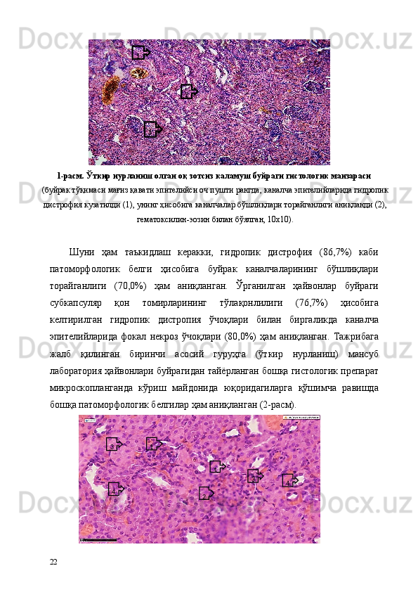 1-расм. Ўткир нурланиш олган оқ зотсиз каламуш буйраги гистологик манзараси 
(буйрак тўқимаси мағиз қавати эпителийси оч пушти рангда, каналча эпителийларида гидропик
дистрофия кузатилди (1), унинг ҳисобига каналчалар бўшлиқлари торайганлиги аниқланди (2),
гематоксилин-эозин билан бўялган, 10х10). 
 
Шуни   ҳам   таъкидлаш   керакки,   гидропик   дистрофия   (86,7%)   каби
патоморфологик   белги   ҳисобига   буйрак   каналчаларининг   бўшлиқлари
торайганлиги   (70,0%)   ҳам   аниқланган.   Ўрганилган   ҳайвонлар   буйраги
субкапсуляр   қон   томирларининг   тўлақонлилиги   (76,7%)   ҳисобига
келтирилган   гидропик   дистропия   ўчоқлари   билан   биргаликда   каналча
эпителийларида   фокал   некроз   ўчоқлари   (80,0%)   ҳам   аниқланган.   Тажрибага
жалб   қилинган   биринчи   асосий   гуруҳга   (ўткир   нурланиш)   мансуб
лаборатория ҳайвонлари буйрагидан тайёрланган бошқа гистологик препарат
микроскопланганда   кўриш   майдонида   юқоридагиларга   қўшимча   равишда
бошқа патоморфологик белгилар ҳам аниқланган (2-расм). 
22                    
1  1  
2  
                  1  
1  
2  3  
3  
4   4   
