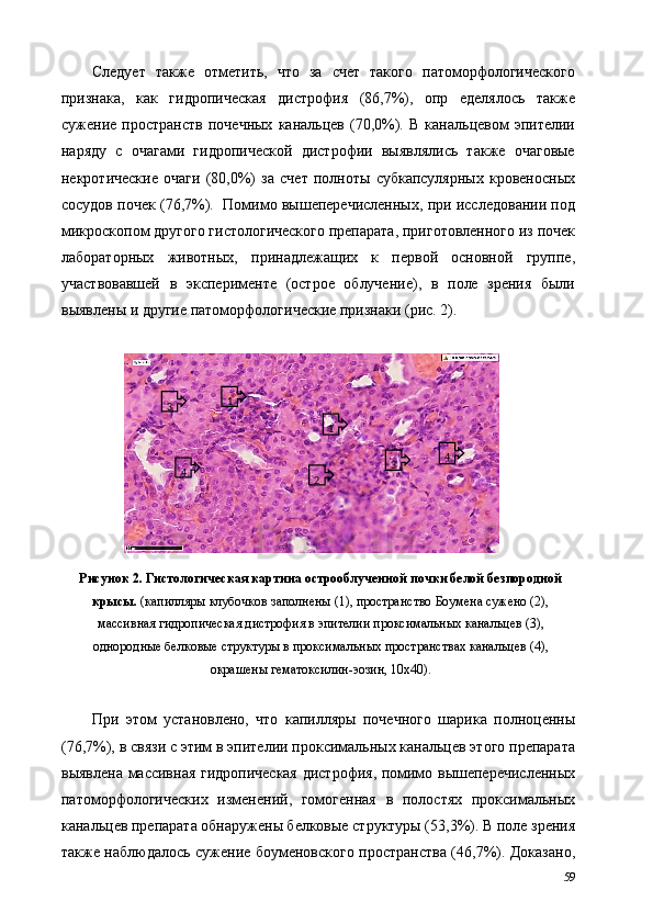 Следует   также   отметить,   что   за   счет   такого   патоморфологического
признака,   как   гидропическая   дистрофия   (86,7%),   опр   еделялось   также
сужение   пространств   почечных   канальцев   (70,0%).   В   канальцевом   эпителии
наряду   с   очагами   гидропической   дистрофии   выявлялись   также   очаговые
некротические   очаги   (80,0%)   за   счет   полноты   субкапсулярных   кровеносных
сосудов почек (76,7%).  Помимо вышеперечисленных, при исследовании под
микроскопом другого гистологического препарата, приготовленного из почек
лабораторных   животных,   принадлежащих   к   первой   основной   группе,
участвовавшей   в   эксперименте   (острое   облучение),   в   поле   зрения   были
выявлены и другие патоморфологические признаки (рис. 2). 
 
Рисунок 2. Гистологическая картина острооблученной почки белой безпородной
крысы.  (капилляры клубочков заполнены (1), пространство Боумена сужено (2),
массивная гидропическая дистрофия в эпителии проксимальных канальцев (3),
однородные белковые структуры в проксимальных пространствах канальцев (4),
окрашены гематоксилин-эозин, 10х40). 
 
При   этом   установлено,   что   капилляры   почечного   шарика   полноценны
(76,7%), в связи с этим в эпителии проксимальных канальцев этого препарата
выявлена массивная гидропическая дистрофия, помимо вышеперечисленных
патоморфологических   изменений,   гомогенная   в   полостях   проксимальных
канальцев препарата обнаружены белковые структуры (53,3%). В поле зрения
также наблюдалось сужение боуменовского пространства (46,7%). Доказано,
59                  1  
1  
2  3  
3  
4   4   