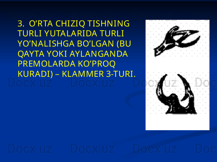 3.   O’RTA  CHIZI Q TISHNING 
TURLI  Y UTALARI DA TURLI 
YO’NALISHGA BO’LGAN (BU 
QAY TA  YOKI AY LANGANDA 
PREMOLARDA KO’PROQ 
KURADI) – KLAMMER 3-TURI. 