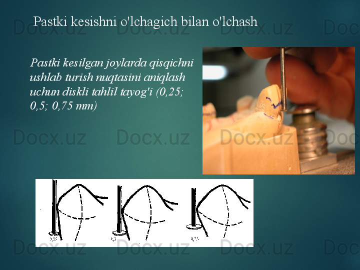 Pastki kesishni o'lchagich bilan o'lchash
Pastki kesilgan joylarda qisqichni 
ushlab turish nuqtasini aniqlash 
uchun diskli tahlil tayog'i (0,25; 
0,5; 0,75 mm)  