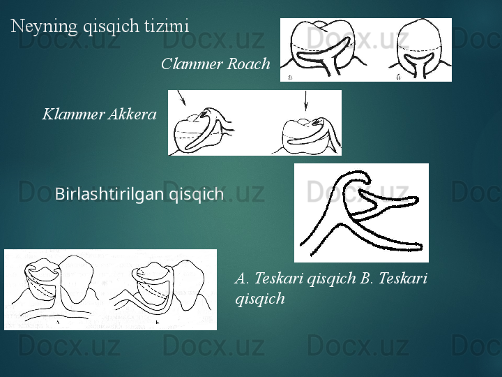 Neyning qisqich tizimi
Clammer Roach
Klammer Akkera
Birlashtirilgan qisqich
А. Teskari qisqich B. Teskari 
qisqich  