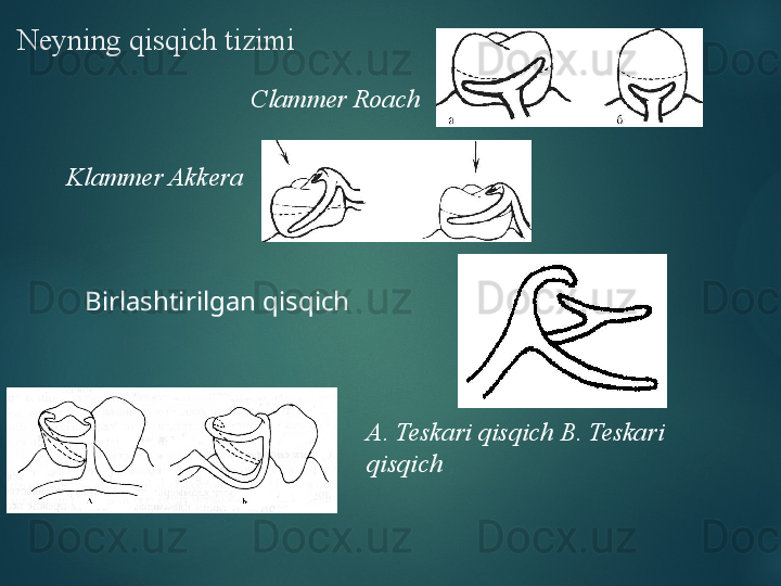 Neyning qisqich tizimi
Clammer Roach
Klammer Akkera
Birlashtirilgan qisqich
А. Teskari qisqich B. Teskari 
qisqich