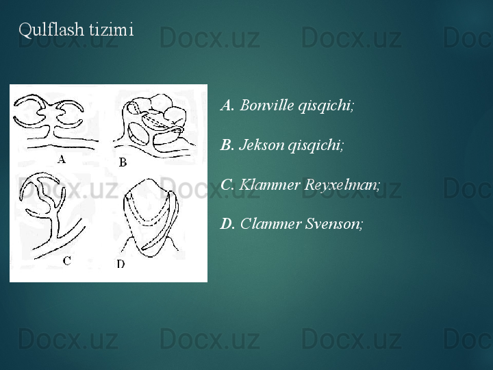 Qulflash tizimi
А.  Bonville qisqichi;
В.  Jekson qisqichi;
С.  Klammer Reyxelman;
D .  Clammer Svenson;