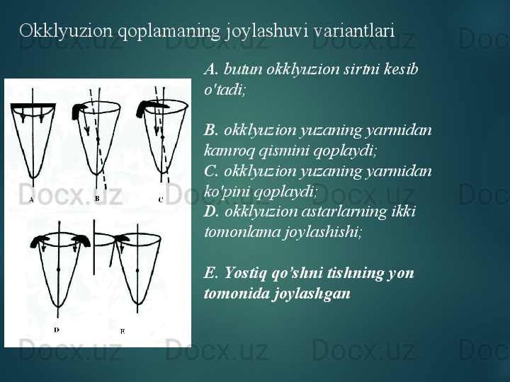 Okklyuzion qoplamaning joylashuvi variantlari
А.  butun okklyuzion sirtni kesib 
o'tadi;
В.  okklyuzion yuzaning yarmidan 
kamroq qismini qoplaydi;
С.  okklyuzion yuzaning yarmidan 
ko'pini qoplaydi;
D .  okklyuzion astarlarning ikki 
tomonlama joylashishi;
E .  Y ostiq qo’shni tishning yon 
tomonida joylashgan  