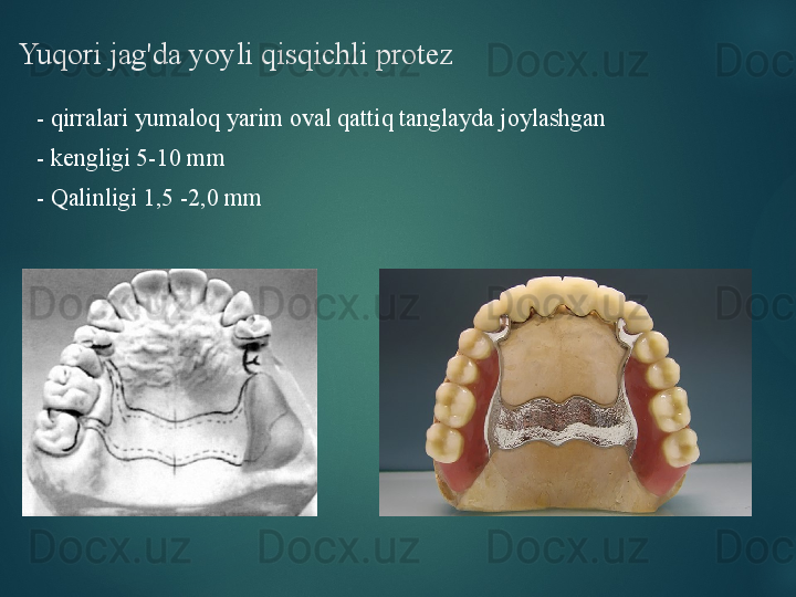 Yuqori jag'da yoyli qisqichli protez
-  qirralari yumaloq yarim oval qattiq tanglayda joylashgan
-  kengligi 5-10 mm  
-  Qalinligi 1,5 -2,0 mm
   