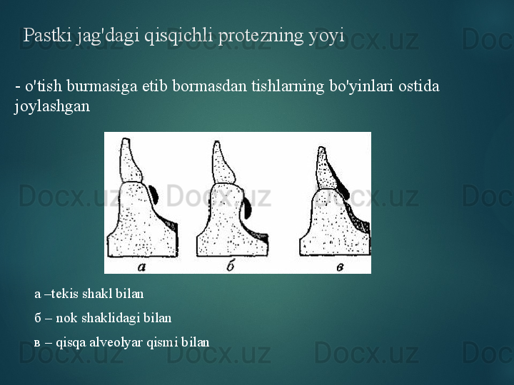 Pastki jag'dagi qisqichli protezning yoyi
-  o'tish burmasiga etib bormasdan tishlarning bo'yinlari ostida 
joylashgan
а – tekis shakl bilan
б –  nok shaklidagi bilan
в –  qisqa alveolyar qismi bilan  