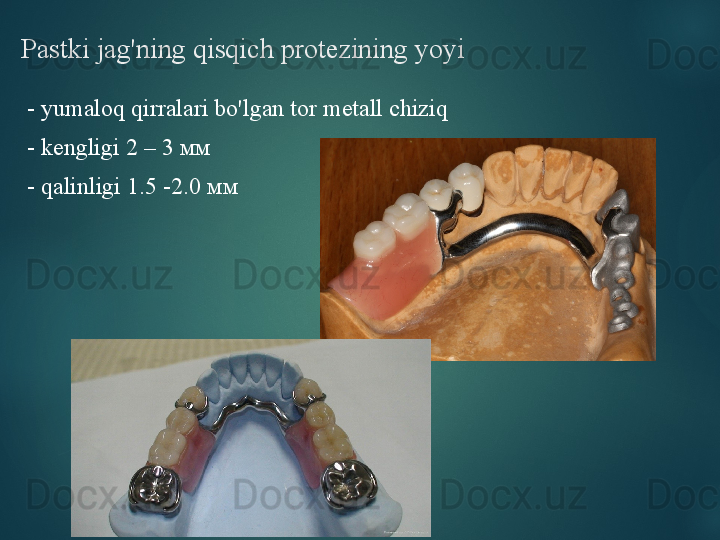 Pastki jag'ning qisqich protezining yoyi
-  yumaloq qirralari bo'lgan tor metall chiziq
-  kengligi  2 – 3 мм 
-  qalinligi  1.5 -2.0 мм   