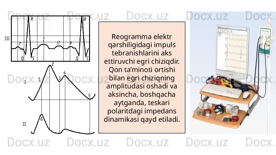 Reogramma elektr 
qarshiligidagi impuls 
tebranishlarini aks 
ettiruvchi egri chiziqdir. 
Qon ta’minoti ortishi 
bilan egri chiziqning 
amplitudasi oshadi va 
aksincha, boshqacha 
aytganda, teskari 
polaritdagi impedans 
dinamikasi qayd etiladi. 