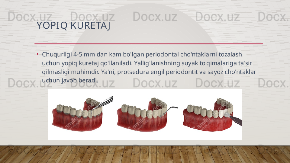 YOPI Q KURETA J
•
Chuqurligi 4-5 mm dan kam bo'lgan periodontal cho'ntaklarni tozalash 
uchun yopiq kuretaj qo'llaniladi. Yallig'lanishning suyak to'qimalariga ta'sir 
qilmasligi muhimdir. Ya'ni, protsedura engil periodontit va sayoz cho'ntaklar 
uchun javob beradi.  