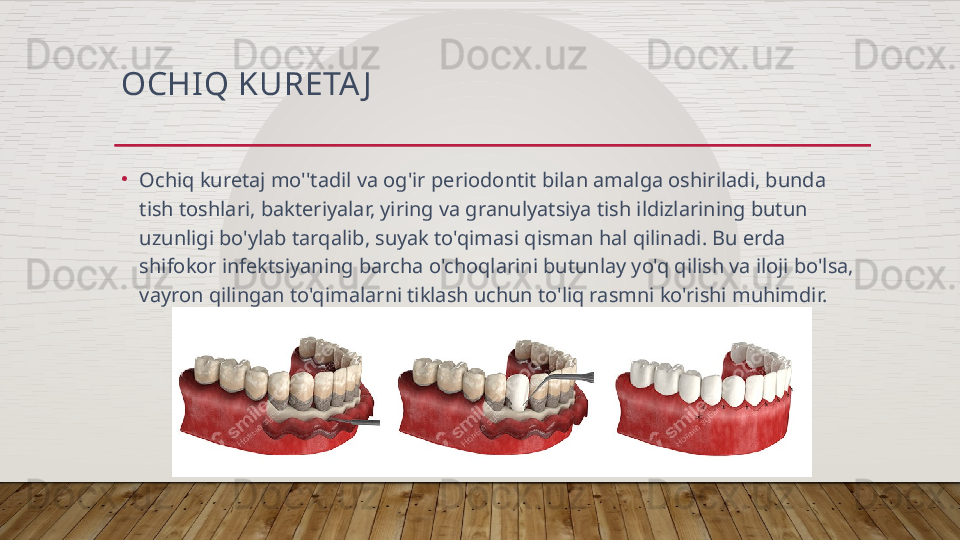 OCHI Q KURETA J
•
Ochiq kuretaj mo''tadil va og'ir periodontit bilan amalga oshiriladi, bunda 
tish toshlari, bakteriyalar, yiring va granulyatsiya tish ildizlarining butun 
uzunligi bo'ylab tarqalib, suyak to'qimasi qisman hal qilinadi. Bu erda 
shifokor infektsiyaning barcha o'choqlarini butunlay yo'q qilish va iloji bo'lsa, 
vayron qilingan to'qimalarni tiklash uchun to'liq rasmni ko'rishi muhimdir.  