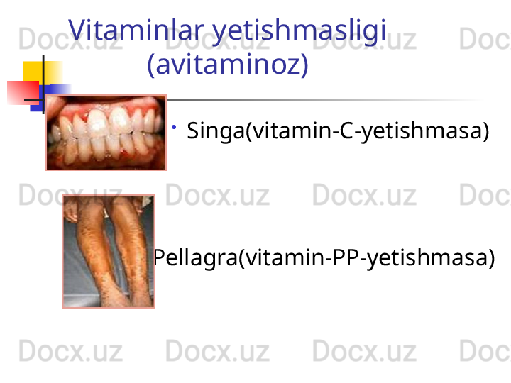 Vitaminlar yetishmasligi 
(avitaminoz)

Singa(vitamin-C-yetishmasa) 

Pellagra(vitamin-PP-yetishmasa) 