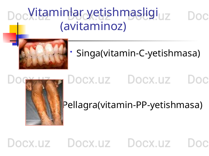 Vitaminlar yetishmasligi 
(avitaminoz)
Singa(vitamin-C-yetishmasa) 
Pellagra(vitamin-PP-yetishmasa)